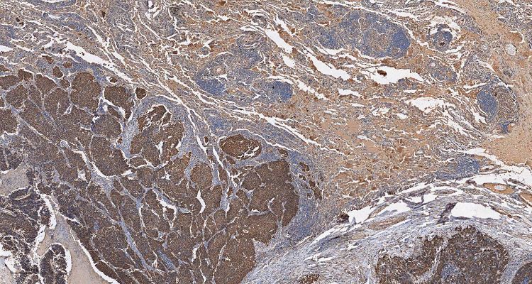 Hepatoma stained with IHC001 Hepatoma stained with IHC001
